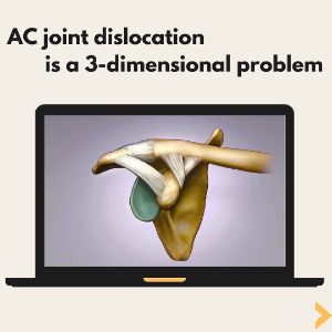 Ac joint dislocation is a 3-dimensional problem
